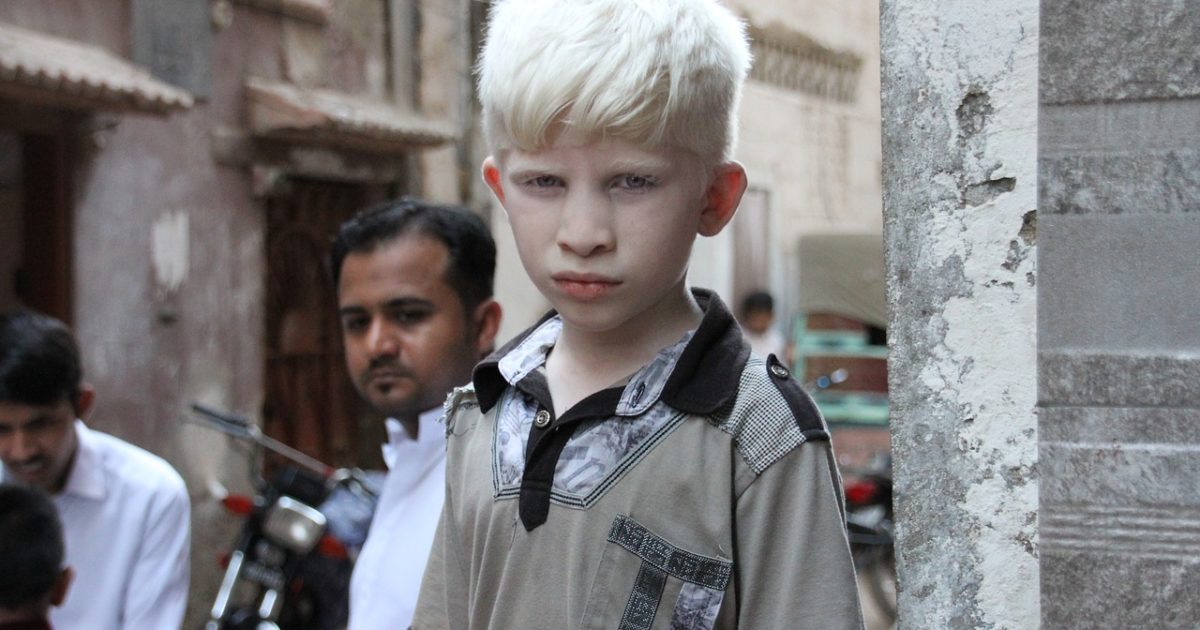 É preciso dar visibilidade à luta das pessoas com albinismo, hoje totalmente invisíveis ao poder  público  e  à  sociedade.